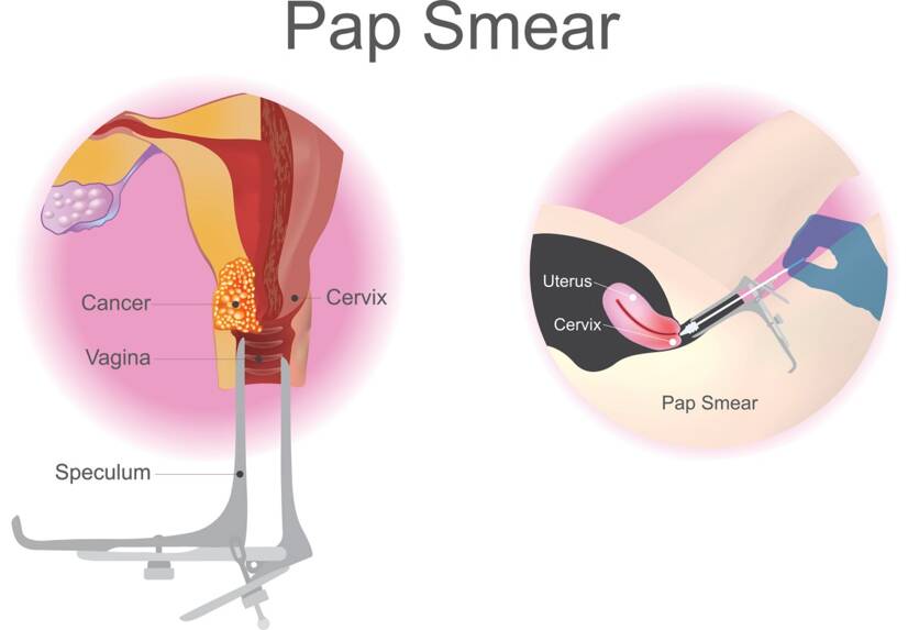 Exame de rastreio, esfregaço cervical Fonte: Getty Images