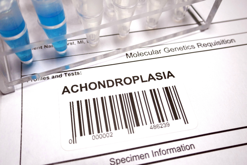 Acondroplasia - Quais são as causas e os sintomas de uma doença óssea congénita?
