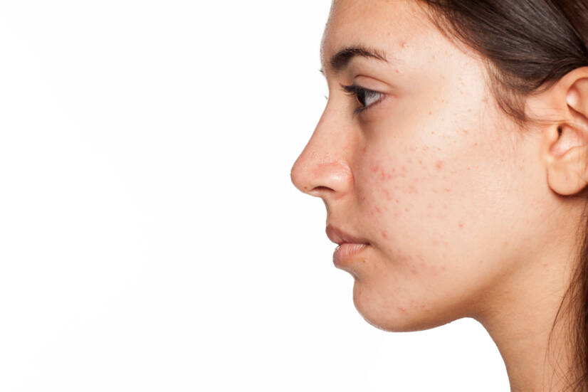 Acne: Que formas de acne conhecemos? Como tratar a pele em casa?