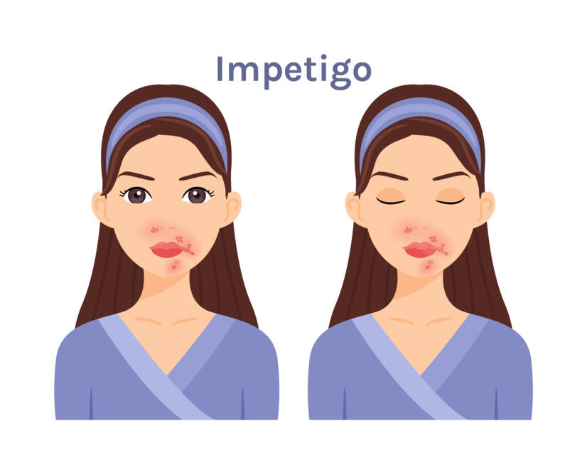 O que é o impetigo, que sintomas apresenta? Infecciosidade e transmissão nas crianças