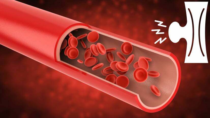 Aneurisma: O que é um aneurisma vascular, como se manifesta e quais são os seus riscos?