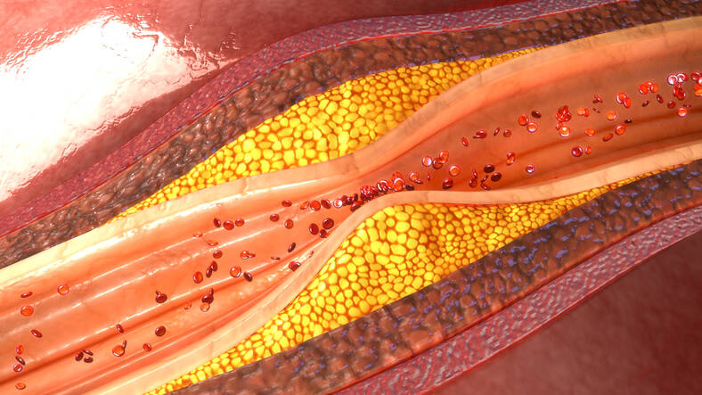 Aterosclerose - conhece os sintomas ou as causas, os riscos, a prevenção?