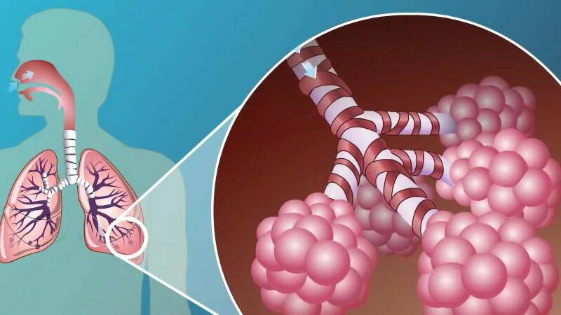 Doença pulmonar obstrutiva crónica: porque ocorre e quem está em risco?