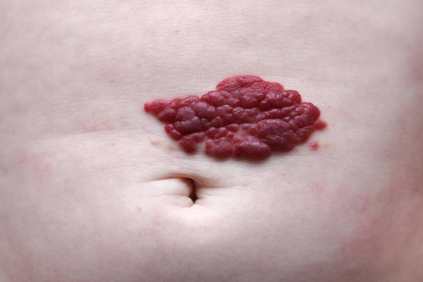 O que é o hemangioma e porque surge? Os seus sintomas e evolução