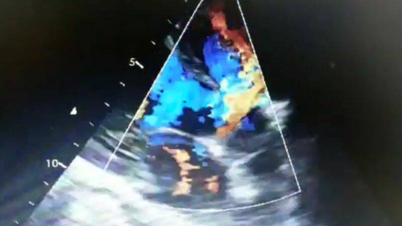 Defeito septal dos ventrículos