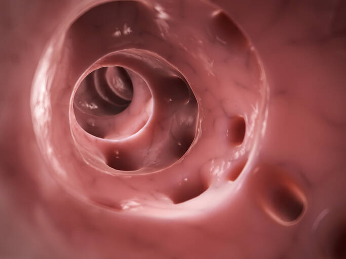Diverticulose e diverticulite: quais são as causas e os sintomas? + Tratamento