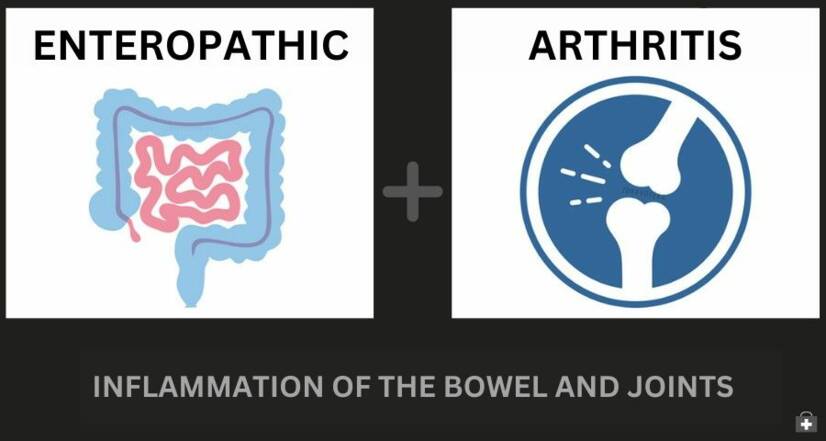 Artrite enteropática e doença inflamatória intestinal: como se relacionam + Sintomas