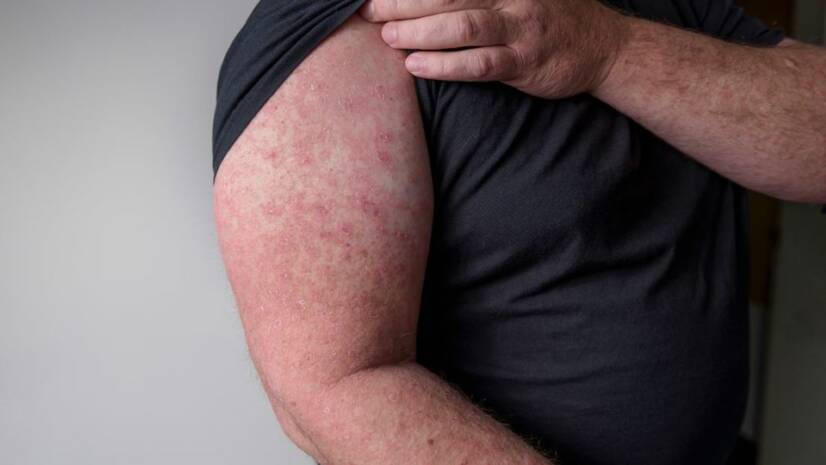 Erisipela - Porque é que a rosácea é uma doença infecciosa, é transmissível? + Sintomas