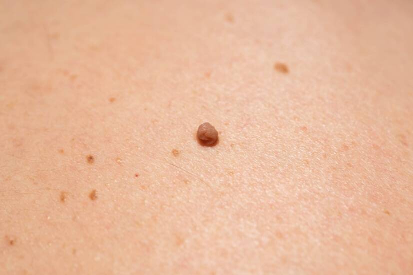 O que é um fibroma na pele, qual o seu aspeto e que sintomas apresenta?