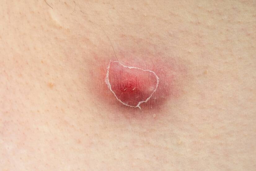 Furúnculo: quais são as causas da inflamação da pele + O que é um carbúnculo