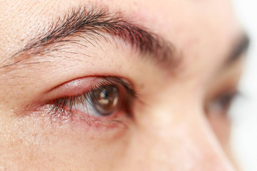 Grão de cevada no olho: porque é que se forma, como é que se trata (Hordeolum + chalazion)