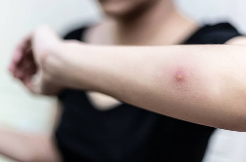 Abcesso cutâneo: o que é, quais as causas e sintomas da infeção cutânea?