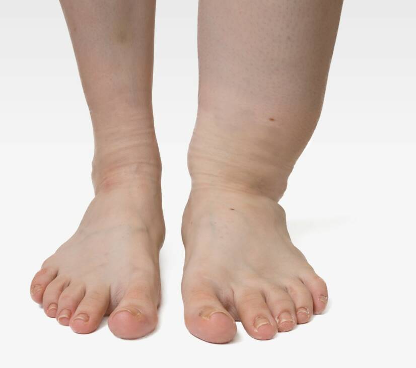 Linfedema: O que é e como se manifesta + Tratamento