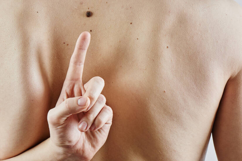 Melanoma maligno - Quais são os sintomas e o seu aspecto? Formas, o seu prognóstico