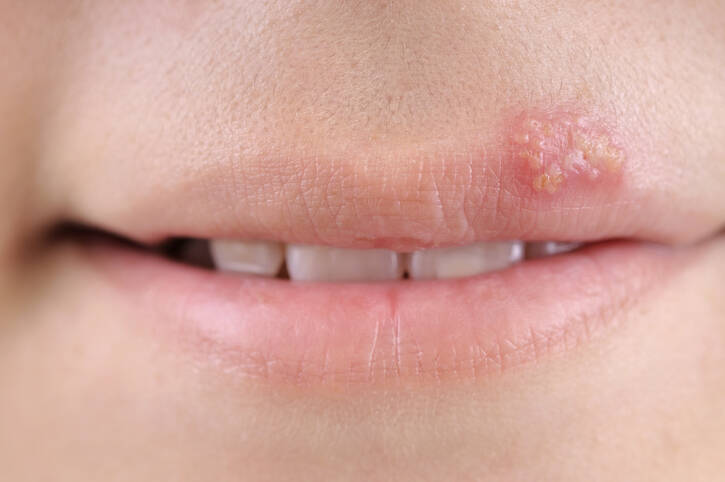 Herpes labial: porque é que o herpes ocorre e o que ajuda no tratamento (o que fazer com o herpes labial)?