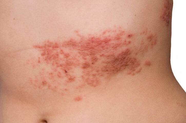 Herpes zóster: transmissão, sintomas, tratamento e complicações do herpes zóster?