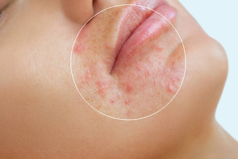 Dermatite perioral: quais são os sintomas? Quais são as causas da doença?
