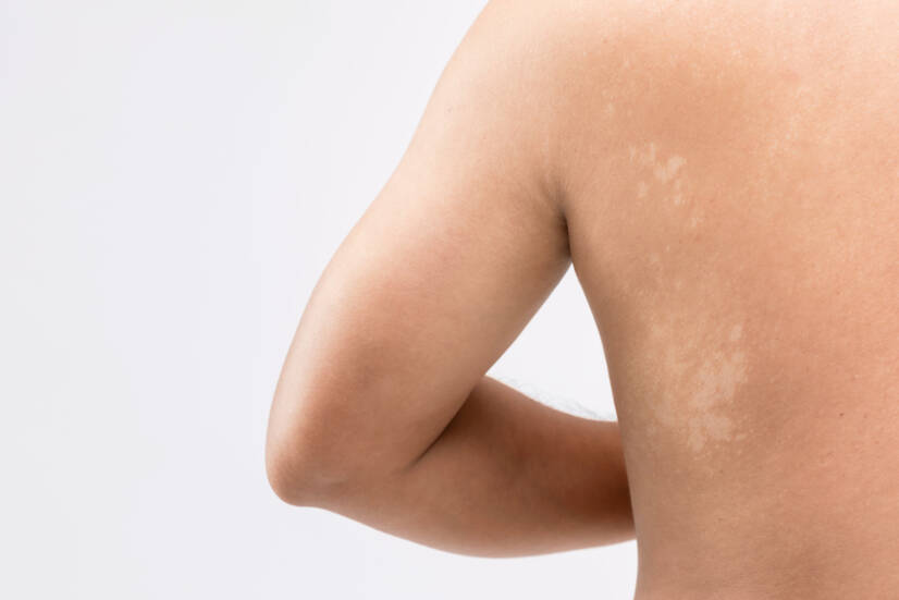 Pitiríase versicolor - O que é, quais os sintomas, causas e transmissão