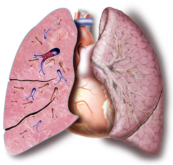 Embolia pulmonar: porque ocorre, como se manifesta, como é detectada e tratada?