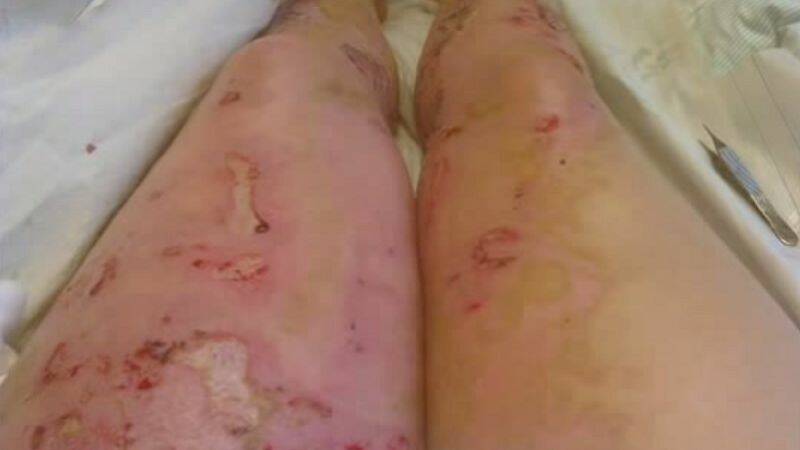 Queimaduras: conhece os graus e os riscos + primeiros socorros e tratamento adequado?