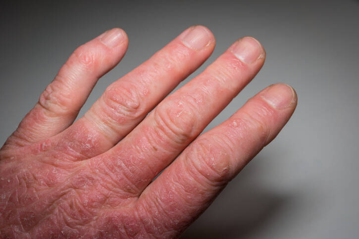 Artrite psoriática: causas e manifestações da psoríase com artrite?