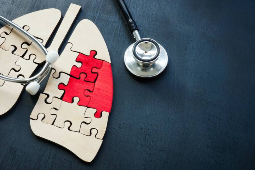 Cancro do pulmão: quais são as causas e os riscos, os sintomas e a evolução?