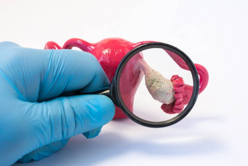 Cancro do ovário - O diagnóstico precoce salva a vida: Como detectá-lo?