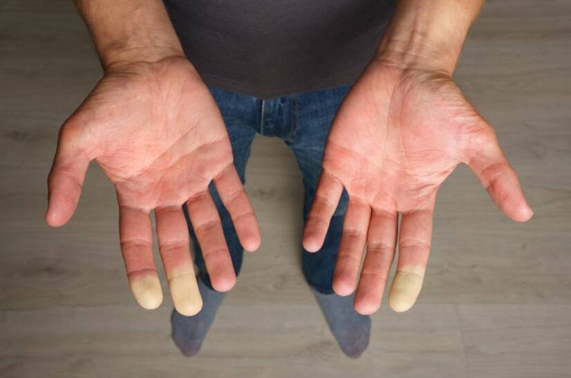 Síndrome de Raynaud: qual é a causa da dormência dos dedos?