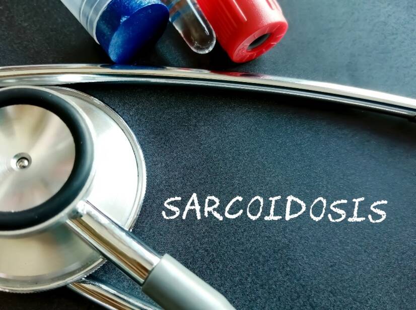 Sarcoidose: O que é a sarcoidose e quais são as suas causas/sintomas? Formas pulmonares e extrapulmonares