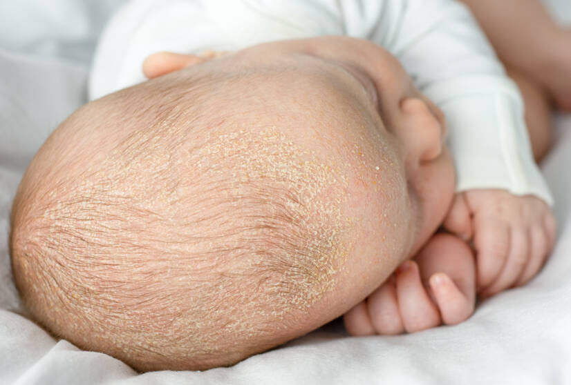 O que é a dermatite seborreica? Quais são os sintomas, as causas? + Distribuição