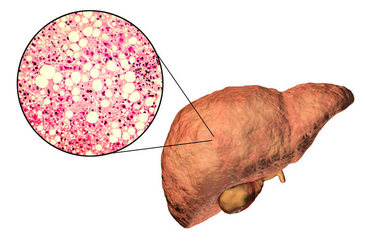 Esteatose hepática: o que é, porque é que surge e como se manifesta? Como tratar o fígado?