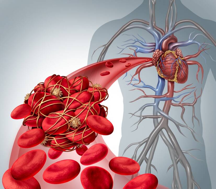 Doença tromboembólica, porque é que ocorre, qual a sua relação com a embolia pulmonar?