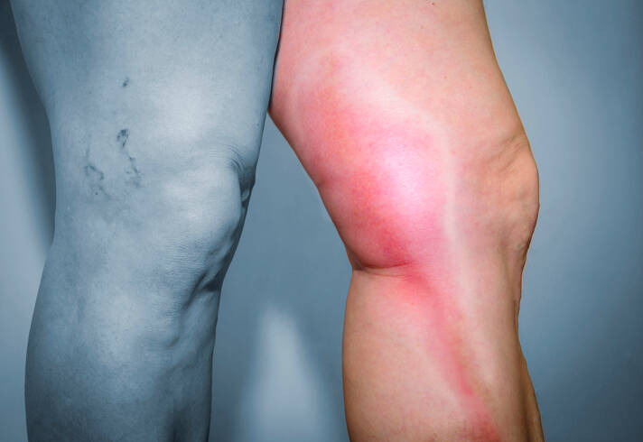 Tromboflebite das veias superficiais: o que é a flebite e porque é que ocorre?