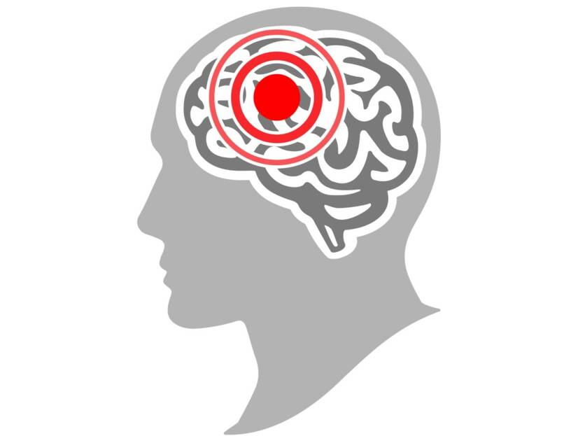 Meningite tuberculosa: o que é e que sintomas apresenta?