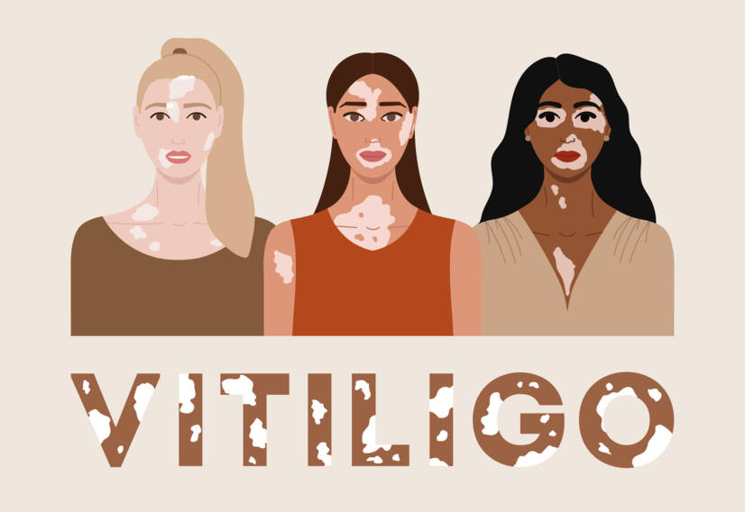 Vitiligo: O que é o vitiligo e quais são as suas causas e sintomas? Quando é que começa?