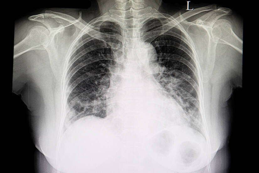 Como é que a pneumonia se manifesta e qual é o tratamento mais eficaz?