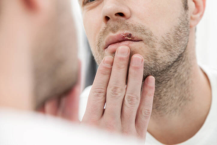 Como se livrar do herpes labial da forma mais eficaz possível? Ajuda rápida e eficaz