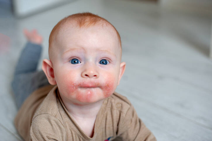 Eczema atópico - o seu filho também sofre com isso?