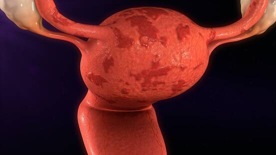 Como é que a endometriose e a infertilidade estão relacionadas + Outros sintomas e problemas de saúde