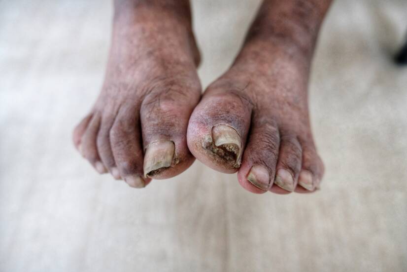 O que é a gangrena, quais são os seus sintomas e tratamento?