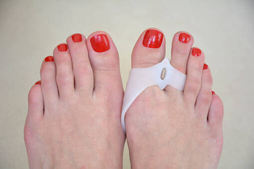 Como ocorre o hallux valgus: joanetes? A influência do calçado + tratamento e talas