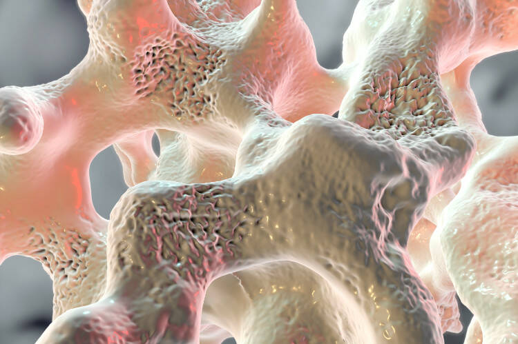 Osteoporose, osteogénese em crianças: porque surge, como se manifesta, como é tratada