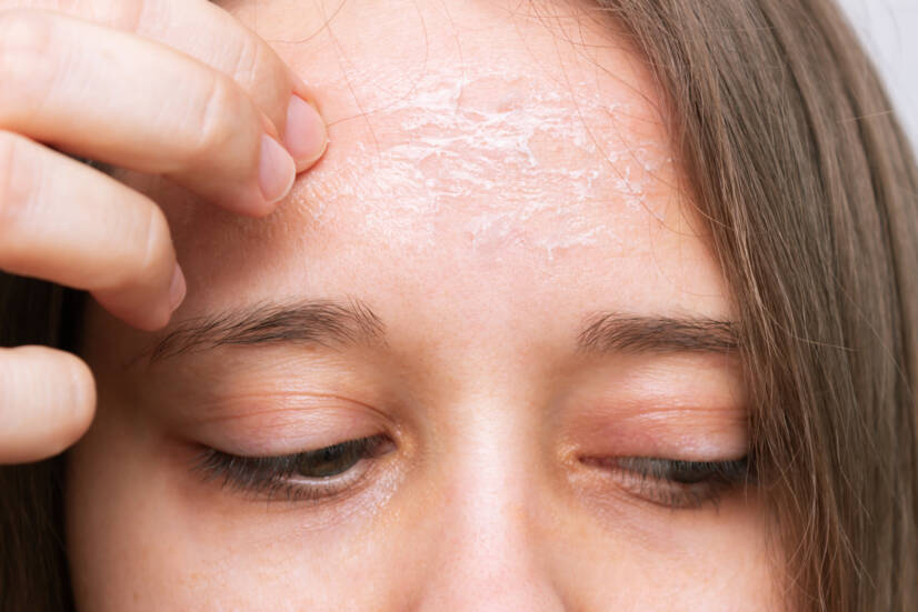 O que é um peeling e como ajuda a pele do rosto e do corpo? + Tipos e variante caseira