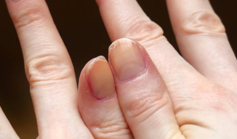 Unhas e dedos dos pés amarelos: defeito estético ou problema de saúde?