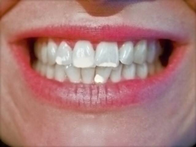 Manchas brancas nos dentes e as suas causas? Como ajudar-se a si próprio e remover as manchas?