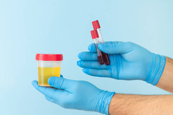 O que significa sangue na urina, hematúria (invisível, na gravidez, nas crianças)?