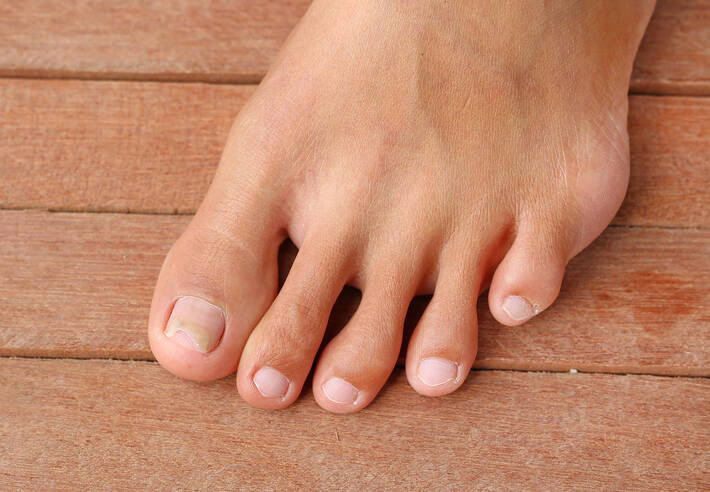 Unhas deformadas - quais são as causas mais comuns?
