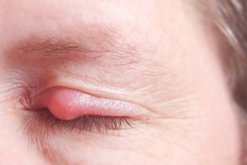 Nódulo palpebral: porque é que se forma um nódulo gordo, branco ou outro, um quisto palpebral?