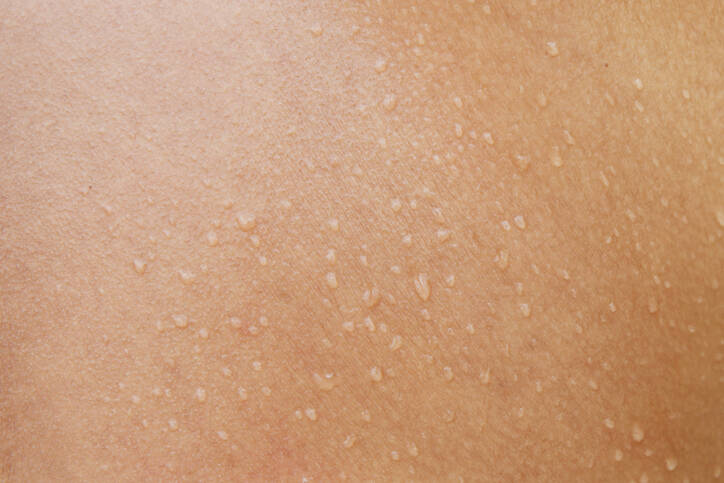 Pele húmida devido a inflamação, dermatite ou eczema? Conheça as causas