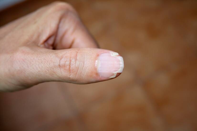 As unhas quebradiças e as suas principais causas? Como combatê-las?
